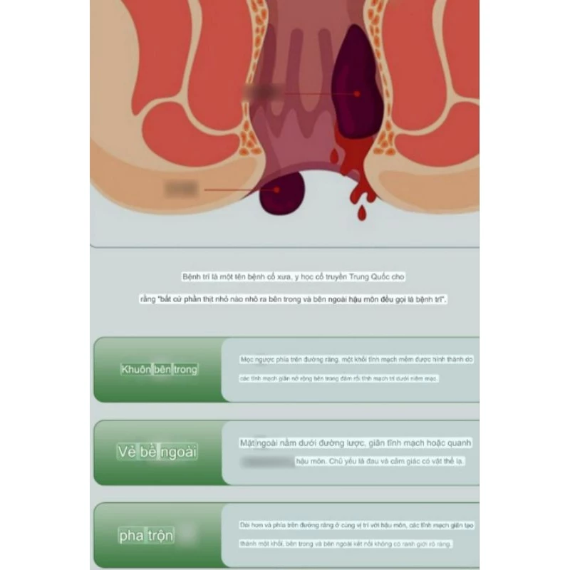 Gel Bôi Trĩ Kreain Nature Hỗ Trợ Giảm Ngứa Rát, Khô Thoáng Vùng Da Nhạy Cảm, Gel Thảo Mộc Làm Dịu Sưng Nóng Hiệu Quả 20g 9 Gel Bôi Trĩ Kreain Nature Hỗ Trợ Giảm Ngứa Rát, Khô Thoáng Vùng Da Nhạy Cảm, Gel Thảo Mộc Làm Dịu Sưng Nóng Hiệu Quả 20g - Ảnh 9