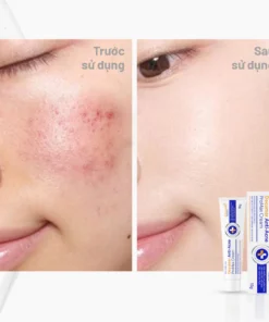 Kem Ngừa Mụn Decumar Anti-Acne ProMax Cream 15g Hỗ Trợ Giảm Mụn Sưng Viêm, Mờ Thâm Sẹo Hiệu Quả 26 decumar11