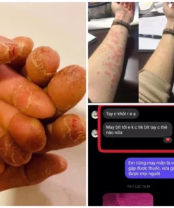 Alternative view of Kem bôi dị ứng Sơn gel móng tay ,lưu huynh ,nam mong ,xà phòng,hoa chất làm tóc …