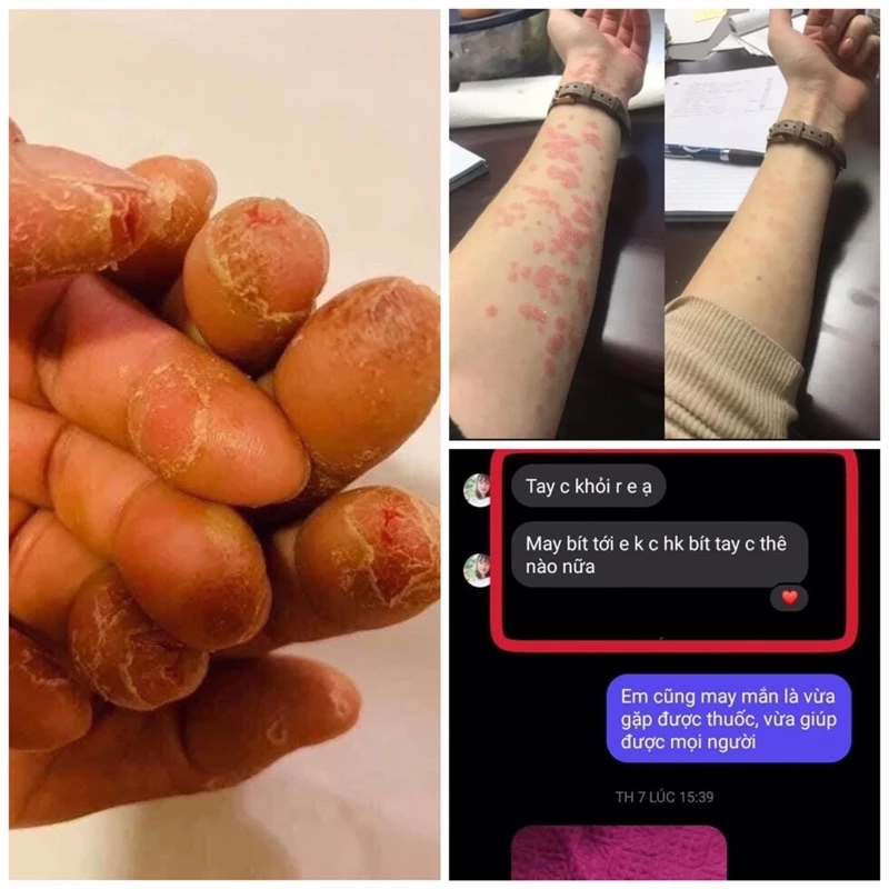 Kem bôi dị ứng Sơn gel móng tay ,lưu huynh ,nam mong ,xà phòng,hoa chất làm tóc … 1 Kem bôi dị ứng Sơn gel móng tay ,lưu huynh ,nam mong ,xà phòng,hoa chất làm tóc … - Ảnh 2