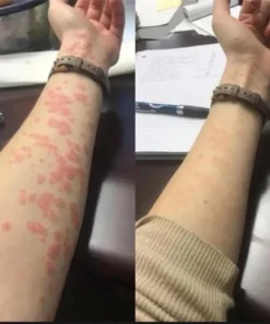 Kem bôi dị ứng Sơn gel móng tay ,lưu huynh ,nam mong ,xà phòng,hoa chất làm tóc … 12 diunggel4