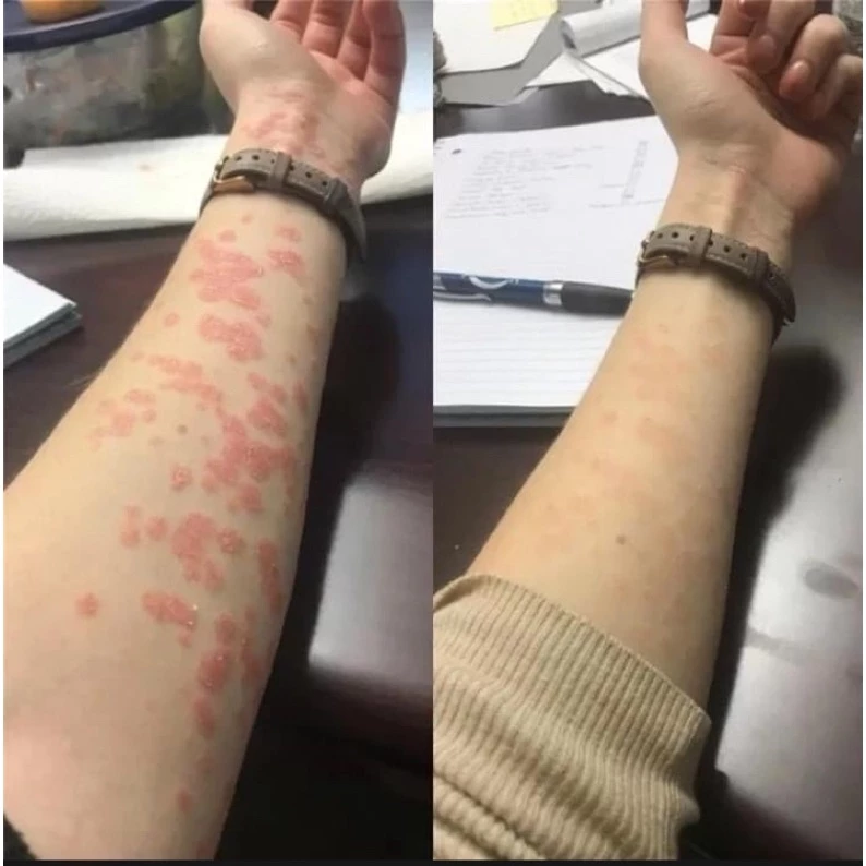 Kem bôi dị ứng Sơn gel móng tay ,lưu huynh ,nam mong ,xà phòng,hoa chất làm tóc … 2 Kem bôi dị ứng Sơn gel móng tay ,lưu huynh ,nam mong ,xà phòng,hoa chất làm tóc … - Ảnh 3