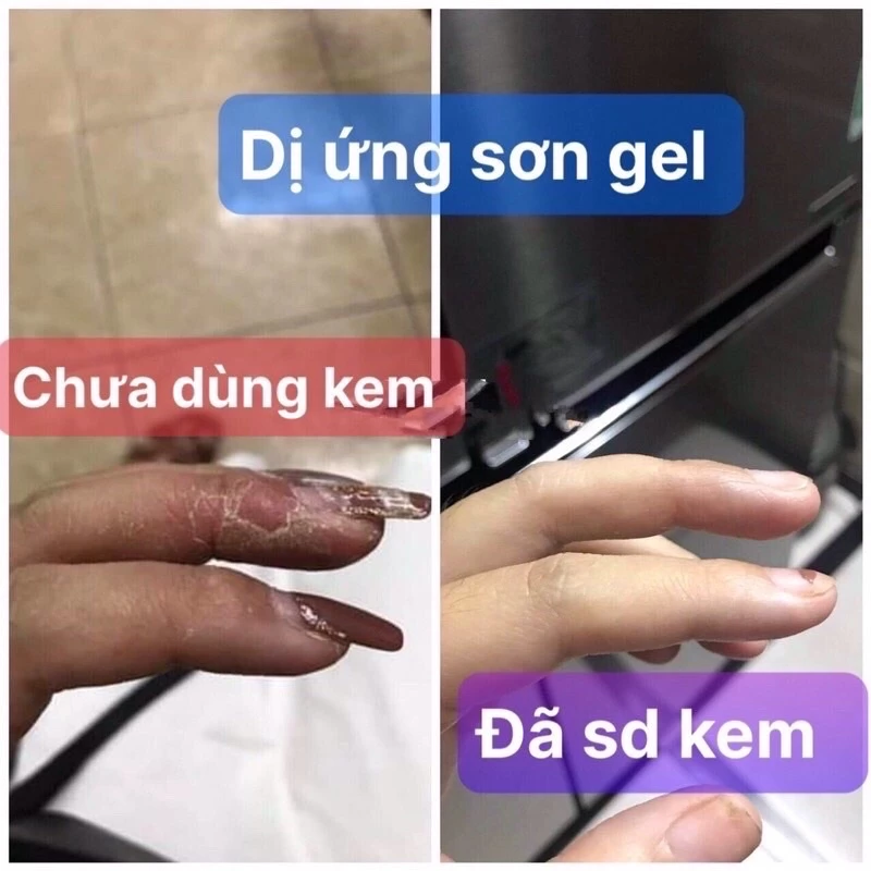 Kem bôi dị ứng Sơn gel móng tay ,lưu huynh ,nam mong ,xà phòng,hoa chất làm tóc … 3 Kem bôi dị ứng Sơn gel móng tay ,lưu huynh ,nam mong ,xà phòng,hoa chất làm tóc … - Ảnh 4