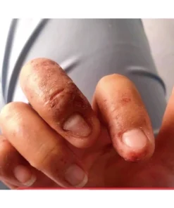 Kem bôi dị ứng Sơn gel móng tay ,lưu huynh ,nam mong ,xà phòng,hoa chất làm tóc … 14 diunggel6