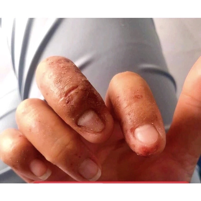 Kem bôi dị ứng Sơn gel móng tay ,lưu huynh ,nam mong ,xà phòng,hoa chất làm tóc … 4 Kem bôi dị ứng Sơn gel móng tay ,lưu huynh ,nam mong ,xà phòng,hoa chất làm tóc … - Ảnh 5