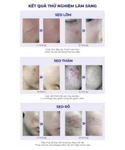 Alternative view of Kem Xóa Sạch Sẹo Thâm, lấp đầy Sẹo Rỗ, Sẹo Lõm Scar Esthetique 10ml của Rejuvaskin