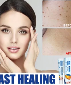 Alternative view of Kem Xóa Mồi Thịt/Nốt Ruồi/Mụn Cóc Chính Hãng 20g - Công Thức Thành Phần Thiên Nhiên Cho Hiệu Quả Loại Bỏ Mồi Thịt/Nốt Ruồi/Mụn