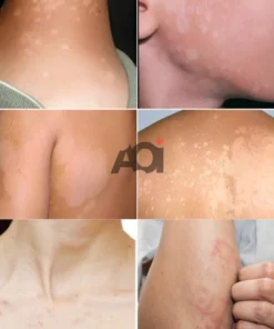 Cao Bôi Lang Ben Sakimi Cổ Truyền Nhật Bản 30ml - Loại Bỏ Đốm Trắng Lang Ben, Bạch Biến, Hắc Lào Hiệu Quả, Tái Tạo Da 12 sakimi5