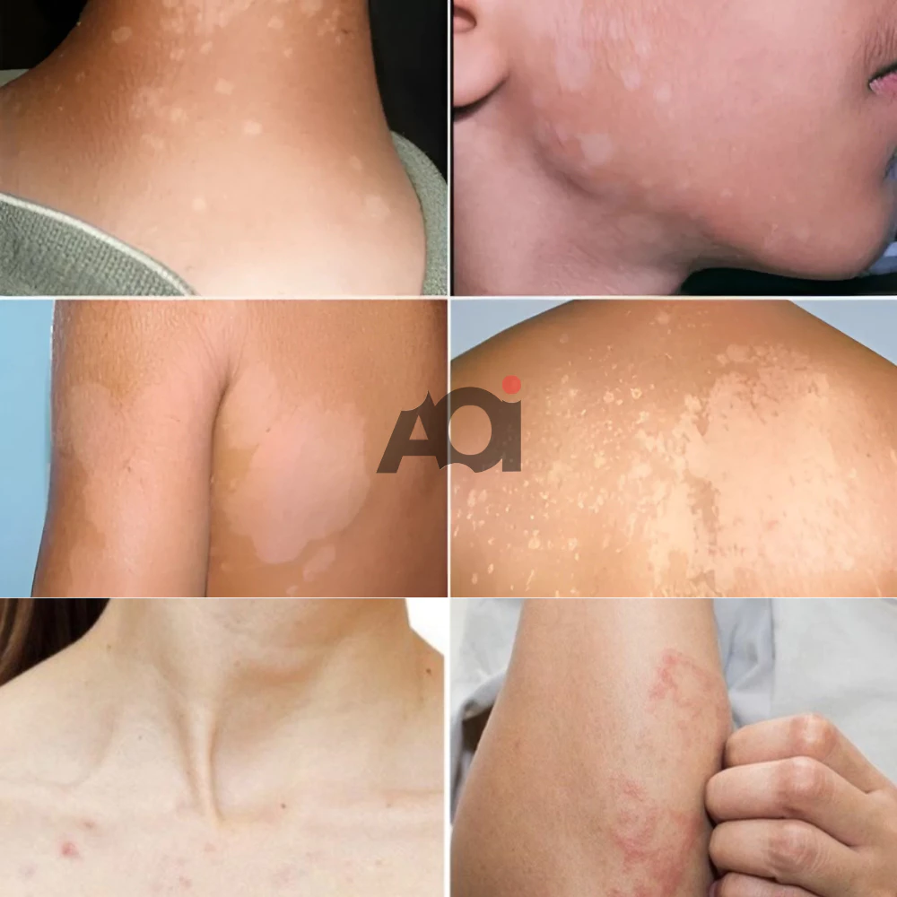 Cao Bôi Lang Ben Sakimi Cổ Truyền Nhật Bản 30ml - Loại Bỏ Đốm Trắng Lang Ben, Bạch Biến, Hắc Lào Hiệu Quả, Tái Tạo Da 3 Cao Bôi Lang Ben Sakimi Cổ Truyền Nhật Bản 30ml - Loại Bỏ Đốm Trắng Lang Ben, Bạch Biến, Hắc Lào Hiệu Quả, Tái Tạo Da - Ảnh 4