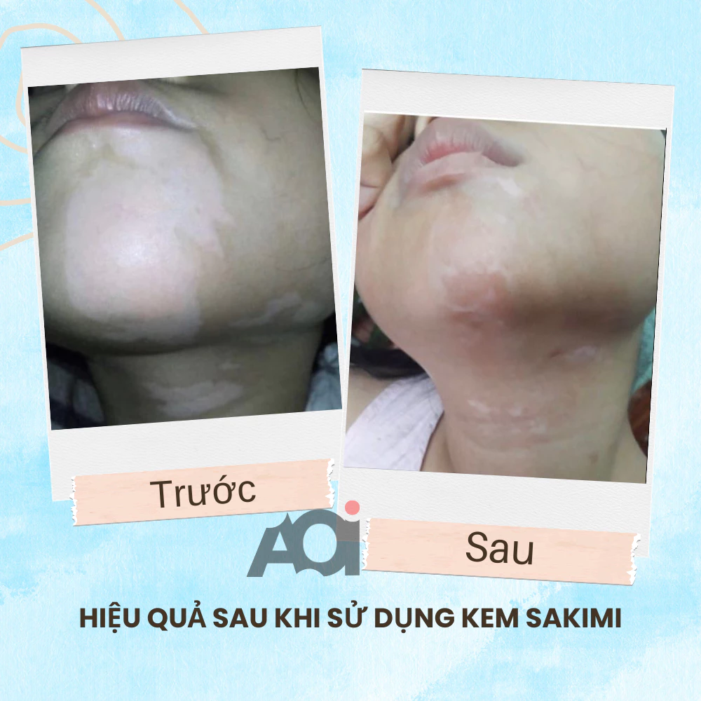 Cao Bôi Lang Ben Sakimi Cổ Truyền Nhật Bản 30ml - Loại Bỏ Đốm Trắng Lang Ben, Bạch Biến, Hắc Lào Hiệu Quả, Tái Tạo Da 5 Cao Bôi Lang Ben Sakimi Cổ Truyền Nhật Bản 30ml - Loại Bỏ Đốm Trắng Lang Ben, Bạch Biến, Hắc Lào Hiệu Quả, Tái Tạo Da - Ảnh 6