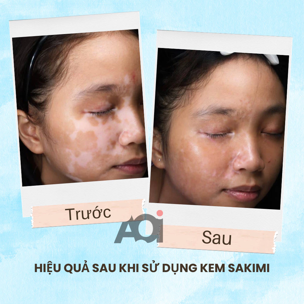 Cao Bôi Lang Ben Sakimi Cổ Truyền Nhật Bản 30ml - Loại Bỏ Đốm Trắng Lang Ben, Bạch Biến, Hắc Lào Hiệu Quả, Tái Tạo Da 6 Cao Bôi Lang Ben Sakimi Cổ Truyền Nhật Bản 30ml - Loại Bỏ Đốm Trắng Lang Ben, Bạch Biến, Hắc Lào Hiệu Quả, Tái Tạo Da - Ảnh 7