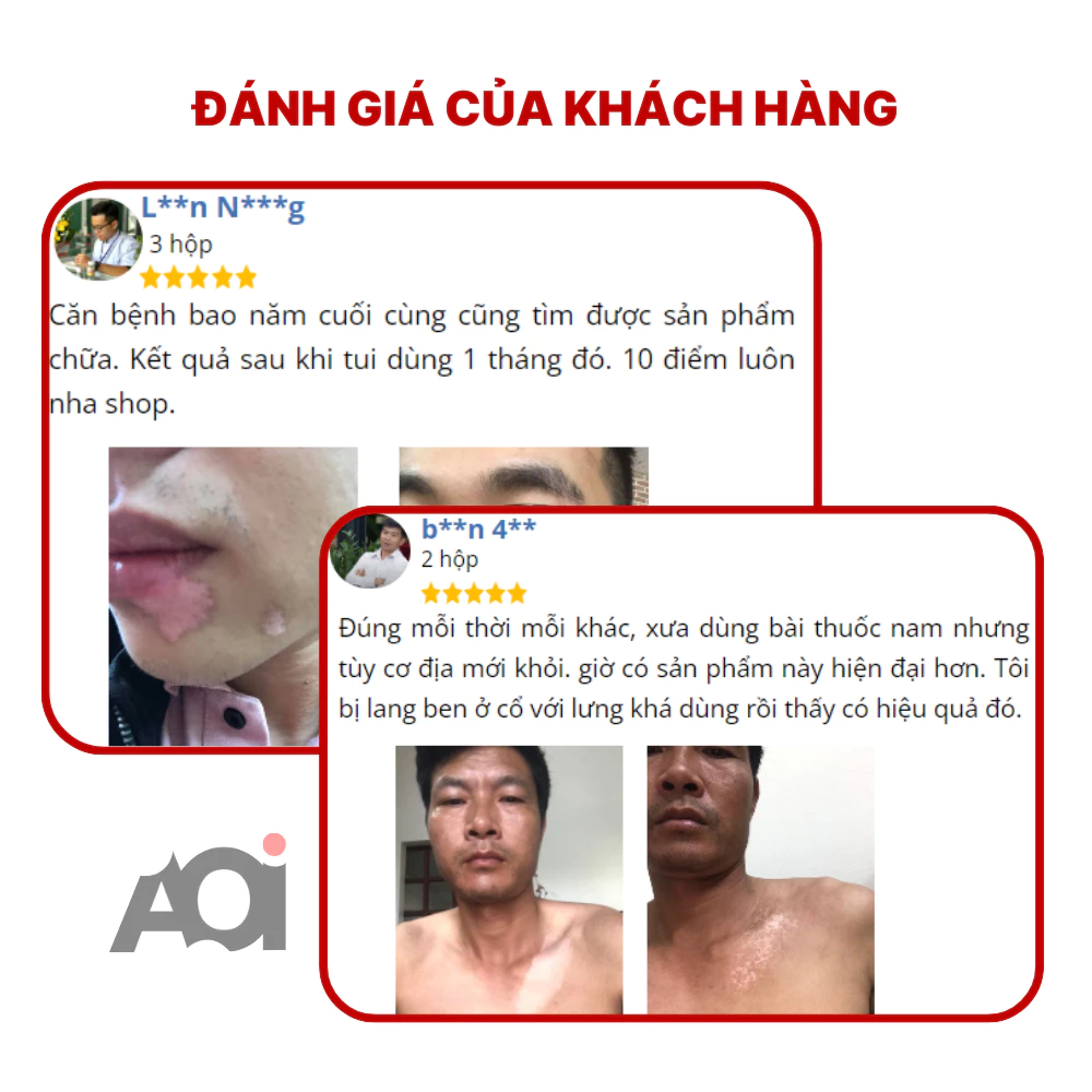 Cao Bôi Lang Ben Sakimi Cổ Truyền Nhật Bản 30ml - Loại Bỏ Đốm Trắng Lang Ben, Bạch Biến, Hắc Lào Hiệu Quả, Tái Tạo Da 7 Cao Bôi Lang Ben Sakimi Cổ Truyền Nhật Bản 30ml - Loại Bỏ Đốm Trắng Lang Ben, Bạch Biến, Hắc Lào Hiệu Quả, Tái Tạo Da - Ảnh 8